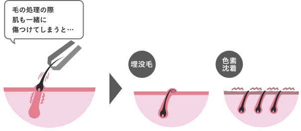 毛の自己処理のリスク